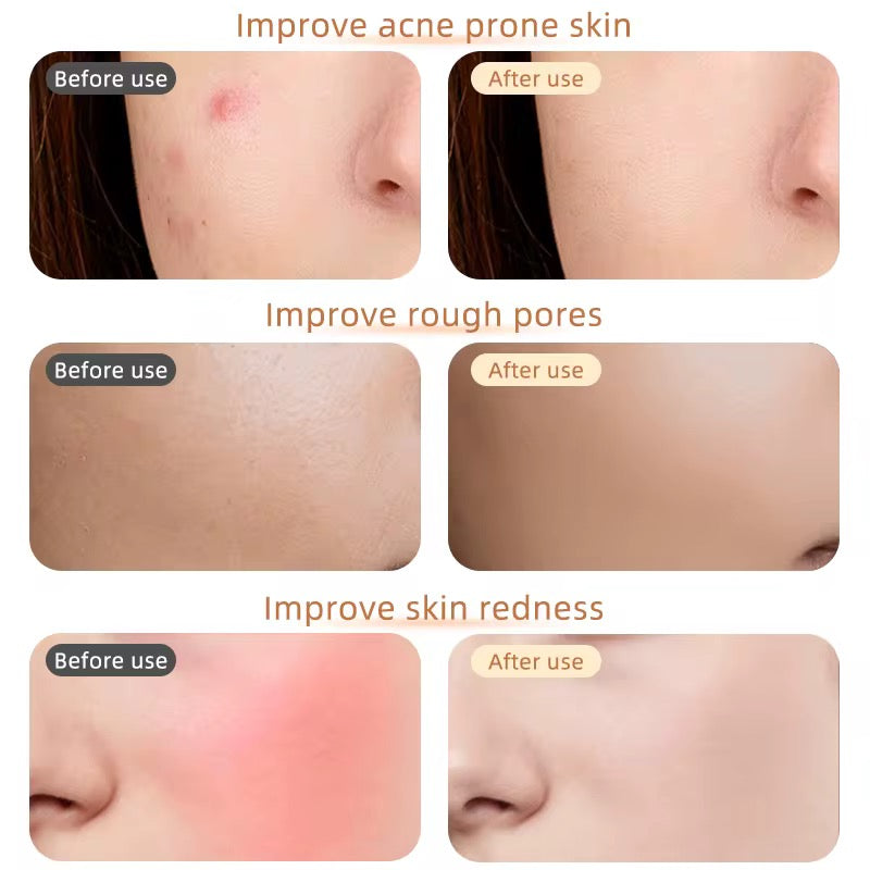 AuraSkin LED Therapy Mask